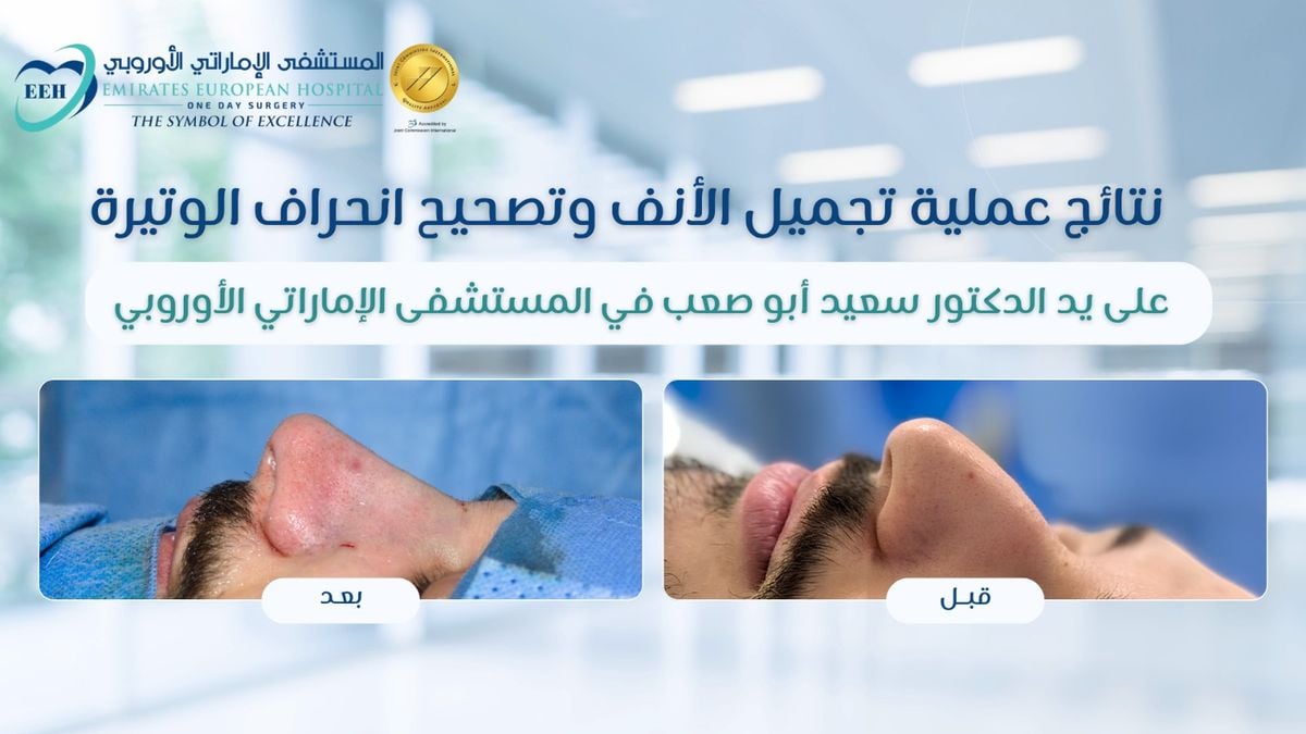 Rhinoplasty