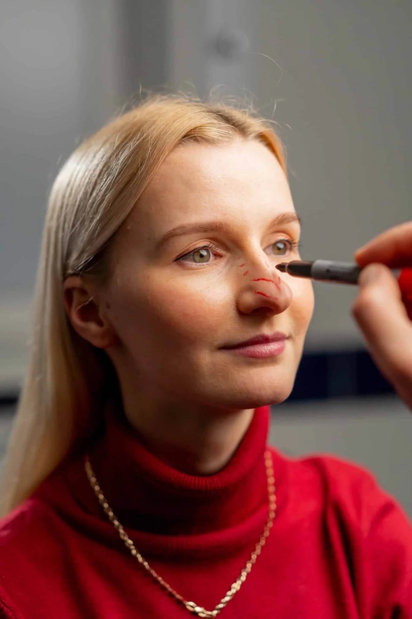Rhinoplasty