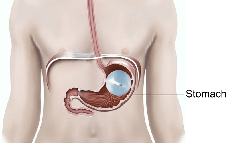 What is a Gastric Balloon?