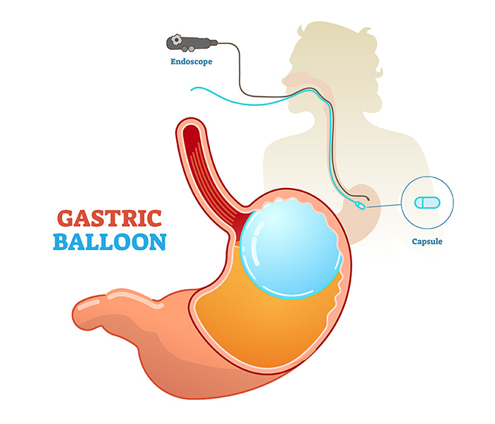 gastric balloon