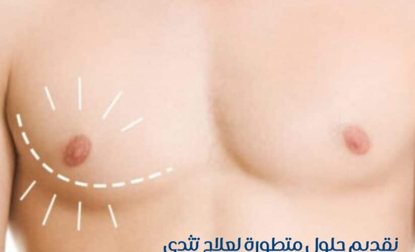 Gynecomastia Surgery at Emirates European Hospital, Sharjah