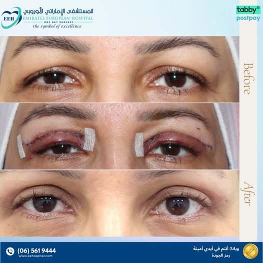 Best blepharoplasty in Sharjah