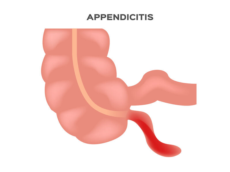 Appendix Surgery in Sharjah