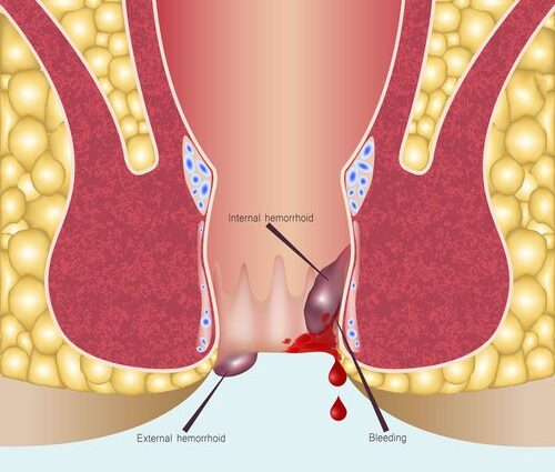 Hemorrhoids surgery in sharjah