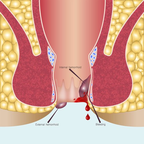 Hemorrhoids surgery in sharjah