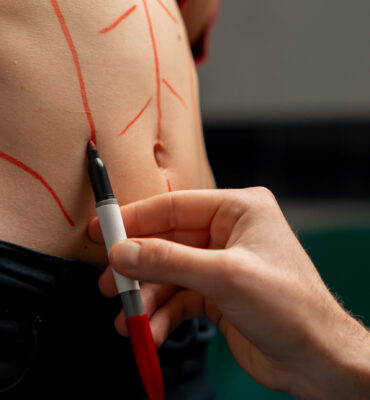 close up in a plastic surgery clinic doctor makes markings on the stomach of a young girl before surgery