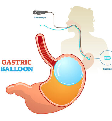 best Gastric Balloon in Sharjah