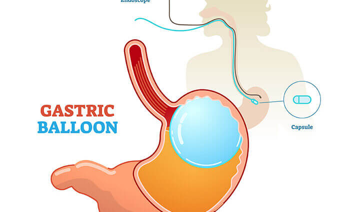 best Gastric Balloon in Sharjah