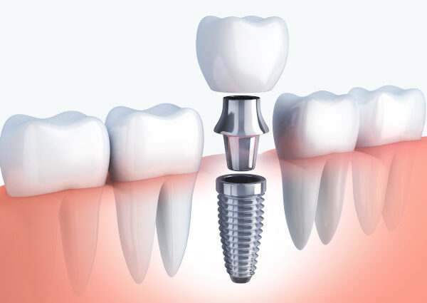 Best Dental Implants Sharjah