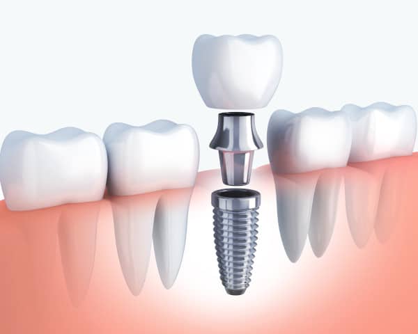 Best Dental Implants Sharjah