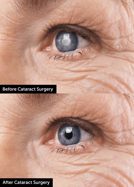 Cataract Surgery in Sharjah | Intraocular Lens (IOL) Implant